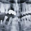 OPG X ray after