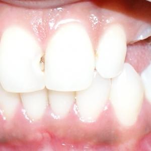 FRACTURED CANINE 